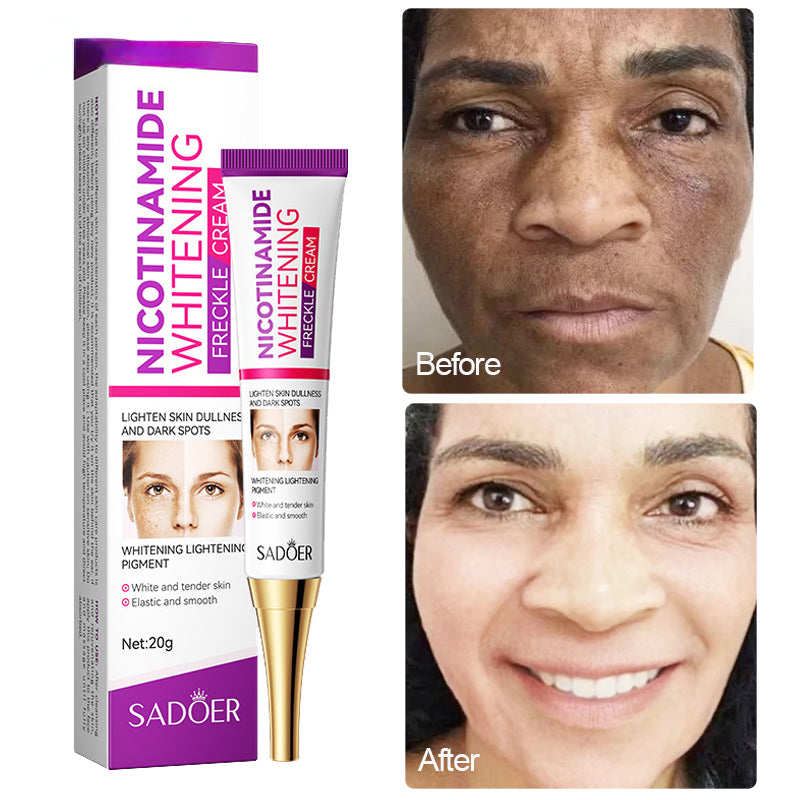 Melasma fading and Freckles Removal Nicotinamide Cream