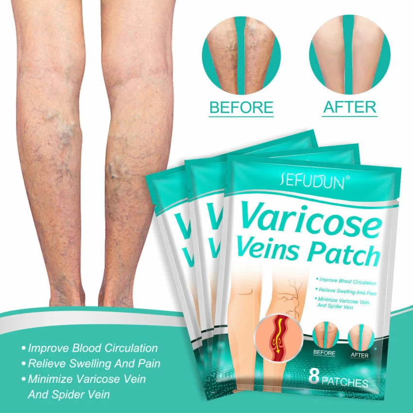 8 PCS Varicose Veins Patches Treatment For Varicose Veins i.e spider veins