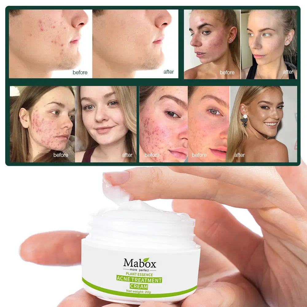 Mabox More Perfect 20g 100% Pure Natural Plant Whitening Moisturizing Acne Treatment Cream