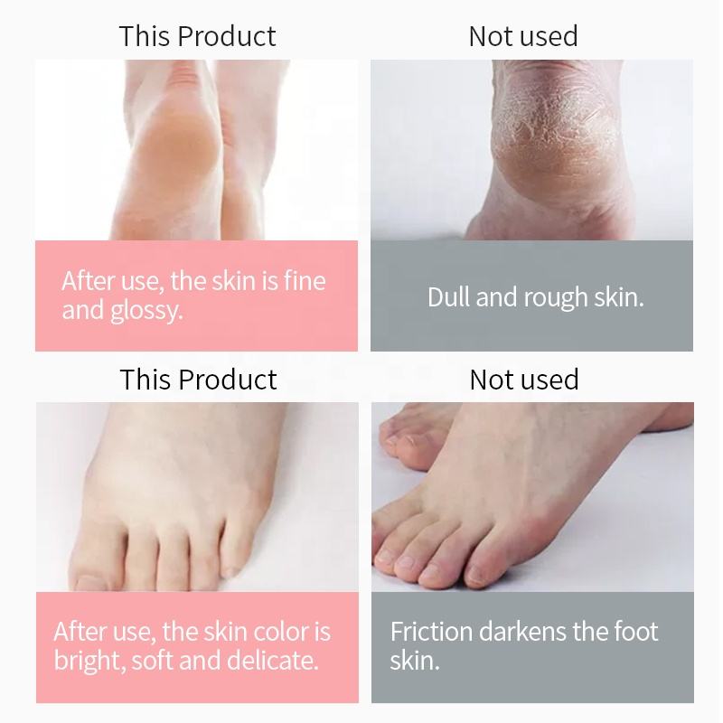 Urea 15% Urea Luxury Foot Cream Baby Like Feet Moisturizing Nutrition Soften Cutin Anti-cracking Foot Cream